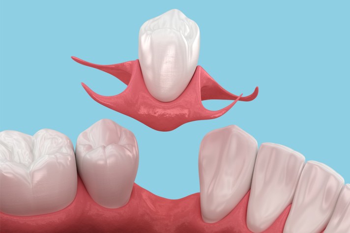 A Long-Term Approach to Replacing Missing Teeth